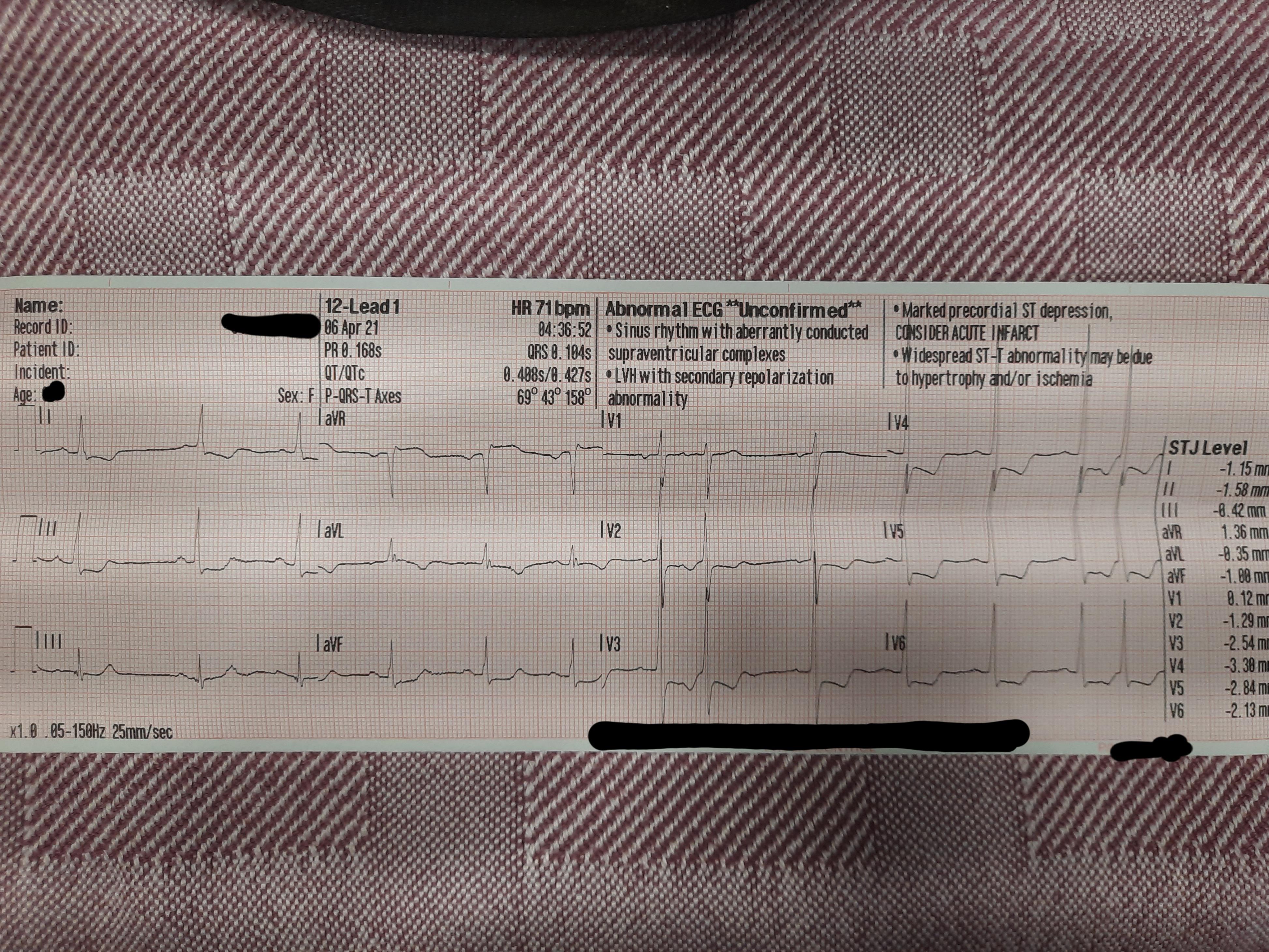 Ekg Strip