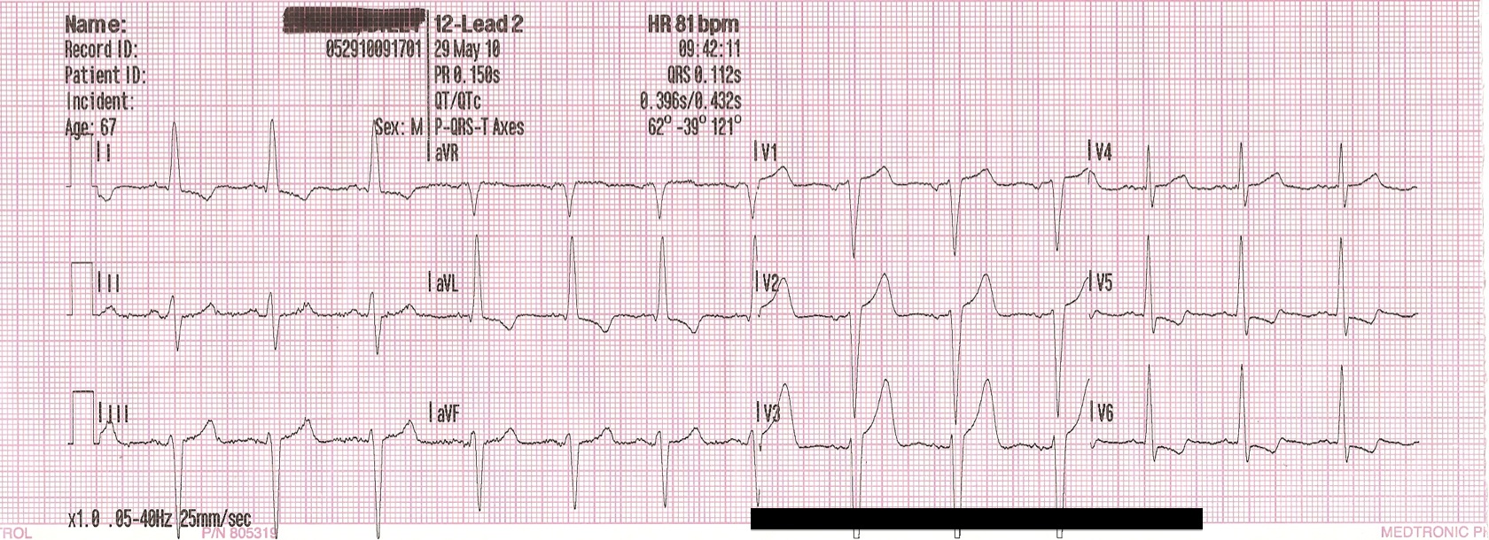 Real EKG for comparison